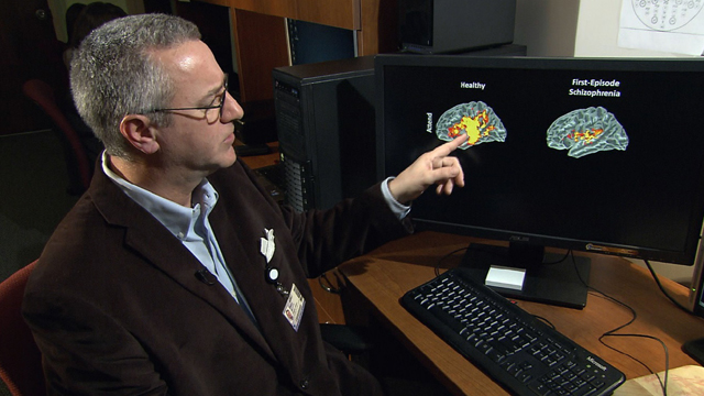 Researcher Dr. Dean Salisbury identifies the differences between healthy and schizophrenic brains.